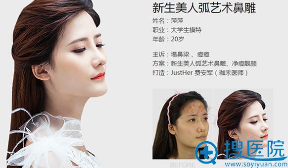 <!--<i data=20240710 data-id=10239></i>--><!--<i data=20240710 data-id=15869></i>-->医生隆鼻案例 <!--<i data=20240710 data-id=10239></i>--><!--<i data=20240710 data-id=15869></i>-->医生隆鼻案例