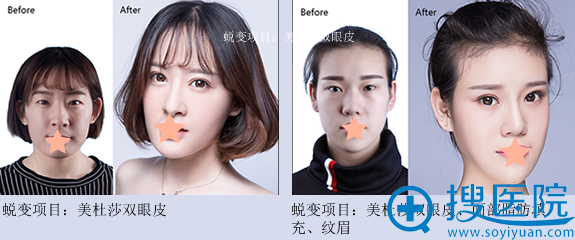 Yestar合肥整容医院塑美案例 Yestar合肥整容医院塑美案例