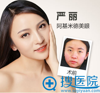 贵阳华美双眼皮案例 贵阳华美双眼皮案例