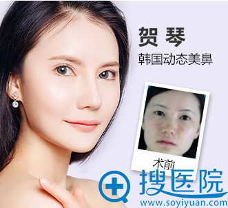 贵阳华美谢占军隆鼻案例 贵阳华美谢占军隆鼻案例