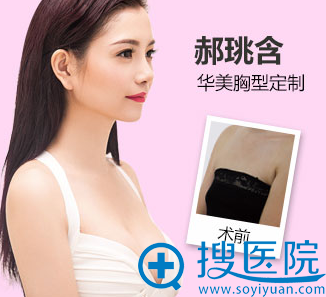 贵阳华美谢亮隆胸案例 贵阳华美谢亮隆胸案例