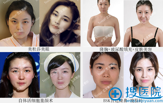 Yestar南京艺星整形医院整形案例 Yestar南京艺星整形医院整形案例