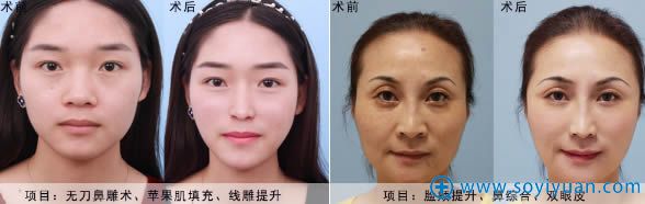 <!--<i data=20240710 data-id=8345></i>-->医疗美容医院袁金学隆鼻案例 <!--<i data=20240710 data-id=8345></i>-->医疗美容医院袁金学隆鼻案例