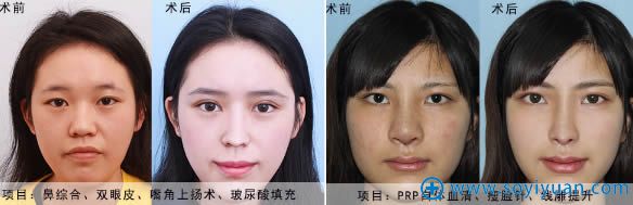 艾美鼻整形不开刀隆鼻技术案例效果图 艾美鼻整形不开刀隆鼻技术案例效果图