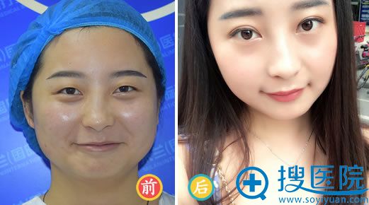 武汉米兰双眼皮手术37天效果图 武汉米兰双眼皮手术37天效果图