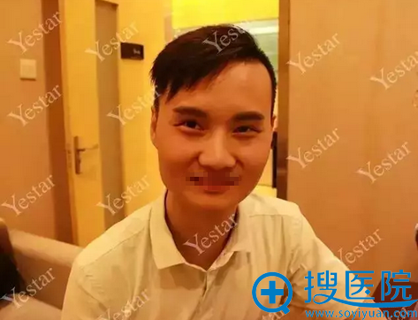 武汉艺星杨国梁Yestar宫廷隆鼻案例术后效果对比照看单身狗逆袭