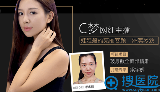深圳美莱梁宇辉玻尿酸全面部精雕案例 深圳美莱梁宇辉玻尿酸全面部精雕案例