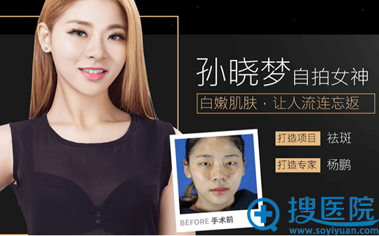 深圳美莱整形美容医院杨鹏祛斑案例 深圳美莱整形美容医院杨鹏祛斑案例