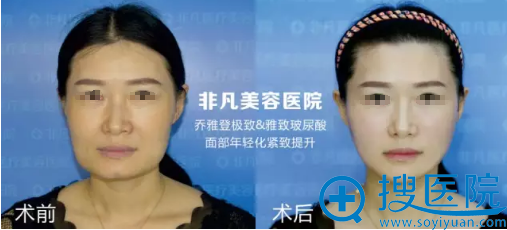 深圳非凡整形美容医院乔雅登玻尿酸除皱案例 深圳非凡整形美容医院乔雅登玻尿酸除皱案例