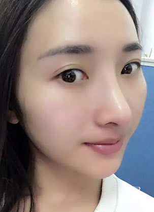 在南京维多利亚医院做达拉斯鼻综合术后1个月恢复图片