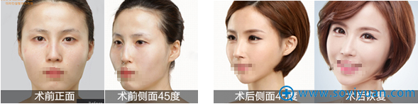 <!--<i data=20240710 data-id=12037></i>-->余成坤双眼皮隆鼻瘦脸案例 <!--<i data=20240710 data-id=12037></i>-->余成坤双眼皮隆鼻瘦脸案例