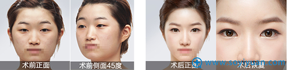 <!--<i data=20240710 data-id=12037></i>-->整形王凯双眼皮瘦脸案例 <!--<i data=20240710 data-id=12037></i>-->整形王凯双眼皮瘦脸案例
