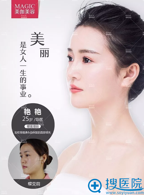 <!--<i data=20240710 data-id=14194></i>-->隆鼻+自体脂肪填充案例 <!--<i data=20240710 data-id=14194></i>-->隆鼻+自体脂肪填充案例