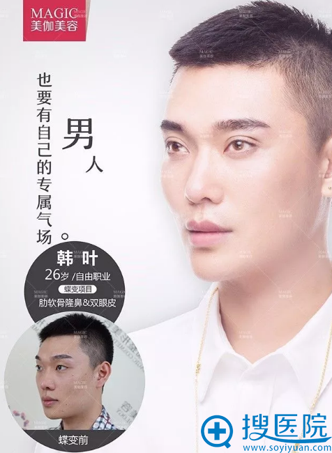 <!--<i data=20240710 data-id=14194></i>-->整形医院隆鼻+双眼皮案例 <!--<i data=20240710 data-id=14194></i>-->整形医院隆鼻+双眼皮案例