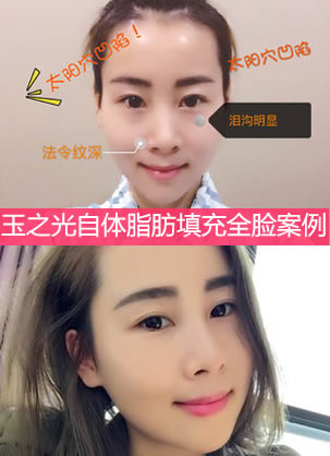张女士分享在成都玉之光通过自体脂肪填充改善太阳穴凹陷日记