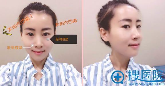 自体脂肪填充全脸前的正侧面照 自体脂肪填充全脸前的正侧面照