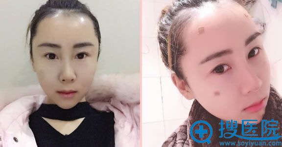 玉之光做完自体脂肪填充全脸即刻效果 玉之光做完自体脂肪填充全脸即刻效果