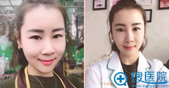 自体脂肪填充1个月的效果 自体脂肪填充1个月的效果