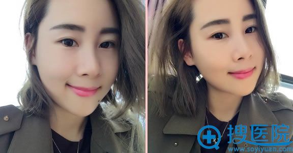 玉之光自体脂肪填充太阳穴2月效果 玉之光自体脂肪填充太阳穴2月效果