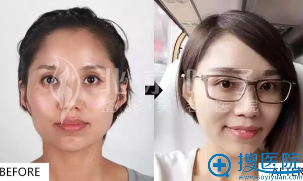 北京叶子整形医院自体脂肪填充全脸前后对比图 北京叶子整形医院自体脂肪填充全脸前后对比图