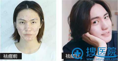 重庆当代整形祛痘治疗效果对比照片 重庆当代整形祛痘治疗效果对比照片
