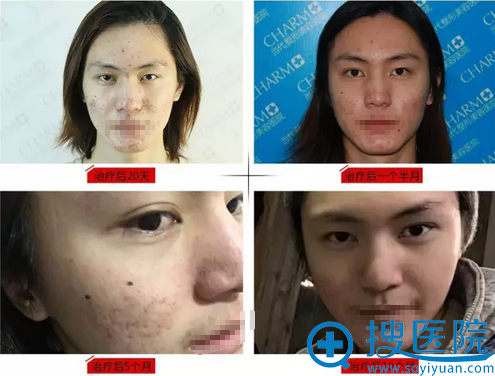 重庆当代祛痘案例前后对比照片 看校草的“战痘”全攻略