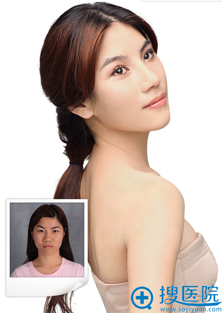 宁波美莱孙明磊主任的隆鼻案例 宁波美莱孙明磊主任的隆鼻案例
