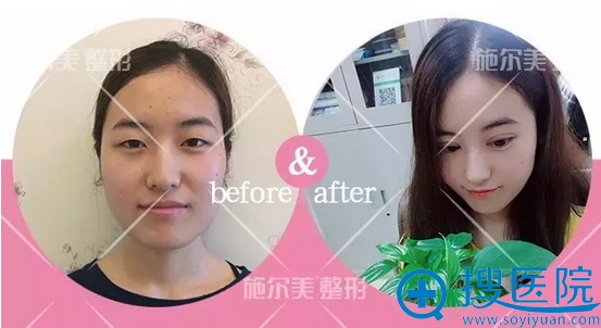 常州哪家医院做双眼皮好?常州施尔美周文双眼皮案例效果图分享