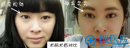 石家庄美莱整形医院双眼皮术前术后对比图 石家庄美莱整形医院双眼皮术前术后对比图