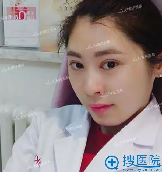 眼整形术后7天拆线的样子 眼整形术后7天拆线的样子