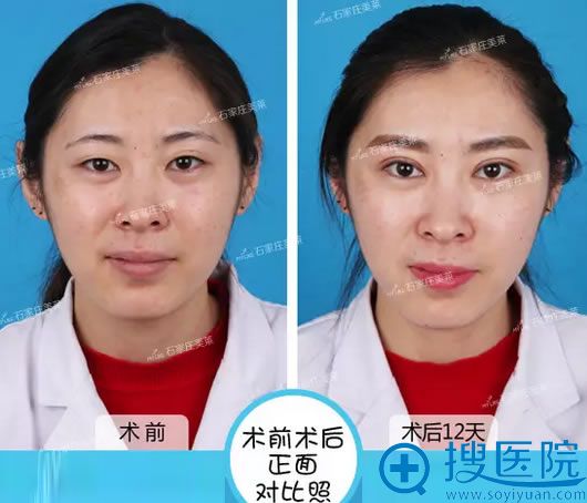田建辉双眼皮术后12天前后对比效果图 田建辉双眼皮术后12天前后对比效果图