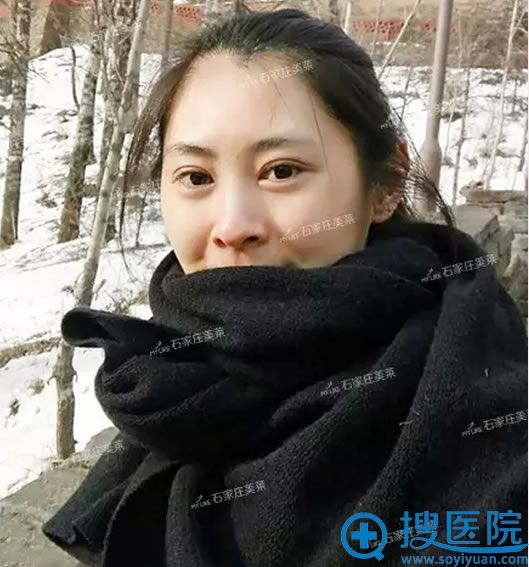 在美莱做双眼皮术后15天恢复图片 在美莱做双眼皮术后15天恢复图片