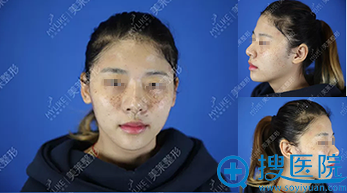 深圳美莱整形医院美国MedLite C6激光祛斑术前照片 深圳美莱整形医院美国MedLite C6激光祛斑术前照片