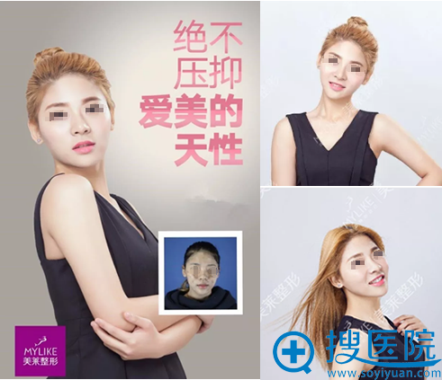 深圳美莱激光祛斑治疗效果展示 深圳美莱激光祛斑治疗效果展示