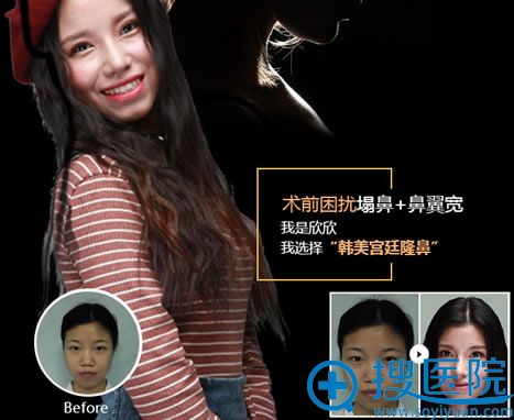 <!--<i data=20240710 data-id=16044></i>-->隆鼻真人案例图 <!--<i data=20240710 data-id=16044></i>-->隆鼻真人案例图