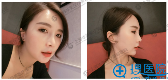 隆鼻3周后的我长这样 隆鼻3周后的我长这样