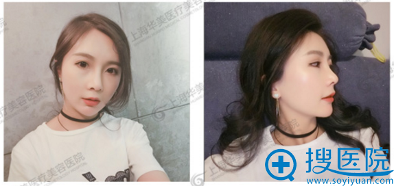 鼻综合第四周,爱上了自己的小翘鼻 鼻综合第四周,爱上了自己的小翘鼻
