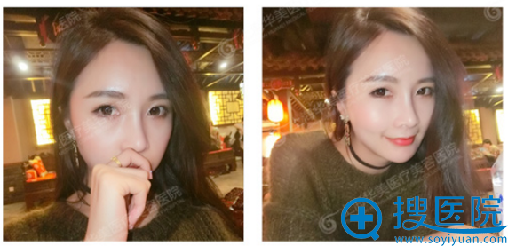 上海华美鼻综合第六周生活照 上海华美鼻综合第六周生活照