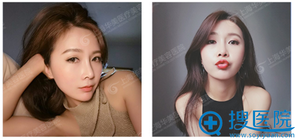 在上海华美找李建做完鼻综合三个月照片分享 在上海华美找李建做完鼻综合三个月照片分享