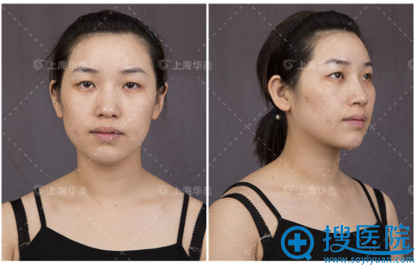 双眼皮术前照片 双眼皮术前照片
