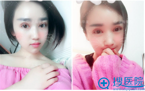 做完双眼皮术后天恢复期图片 做完双眼皮术后天恢复期图片