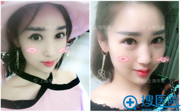 上海华美双眼皮术后两个月生活照 上海华美双眼皮术后两个月生活照