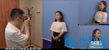 小雨拍摄达拉斯隆鼻术前照 小雨拍摄达拉斯隆鼻术前照