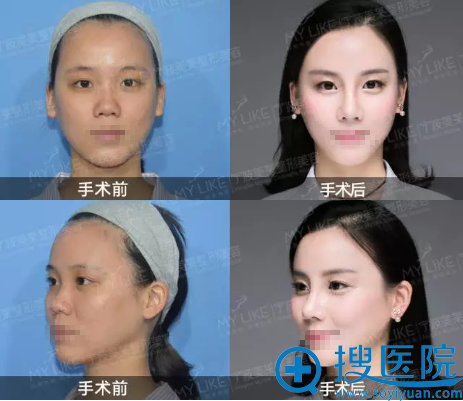 宁波美莱孙明磊达拉斯隆鼻前后对比照片 宁波美莱孙明磊达拉斯隆鼻前后对比照片