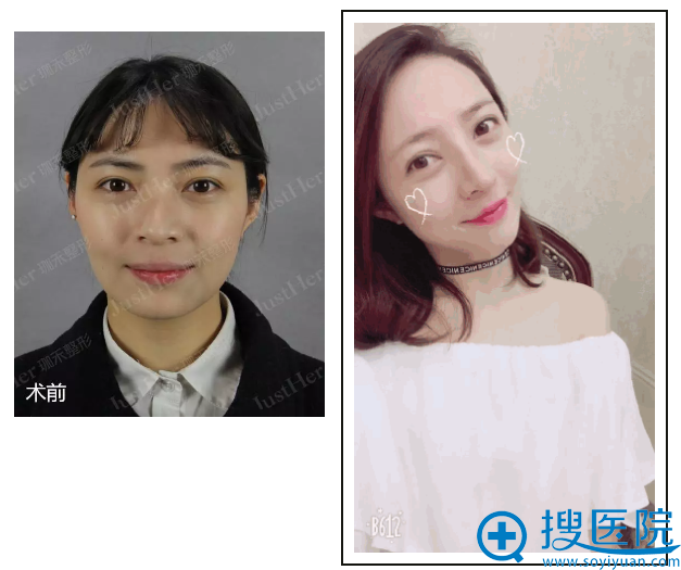 宁波哪家鼻子做得好 宁波珈禾医院肋软骨鼻综合1个月变混血公主