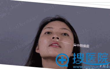 鼻综合术前照片 鼻综合术前照片