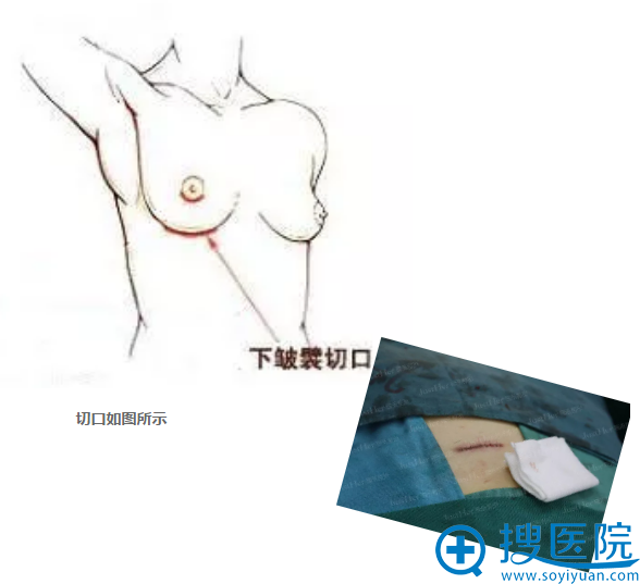 取肋软骨的切口示意图 取肋软骨的切口示意图
