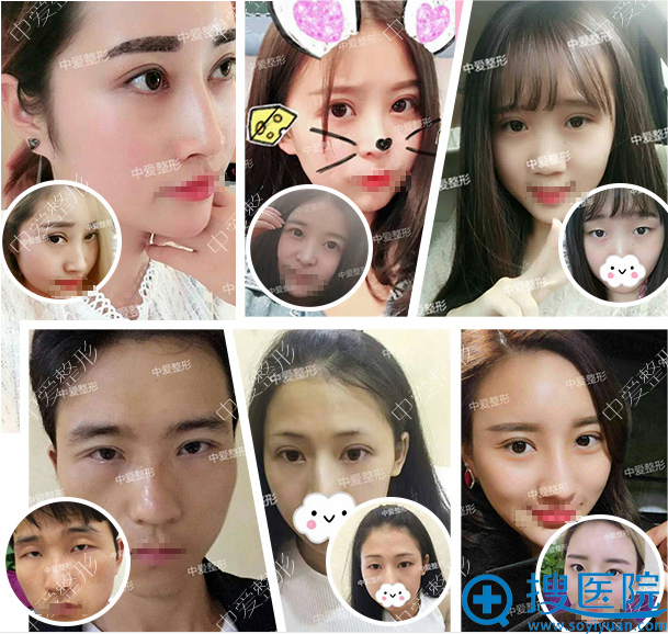 <!--<i data=20240710 data-id=12555></i>-->整形李登进眼鼻整形案例 <!--<i data=20240710 data-id=12555></i>-->整形李登进眼鼻整形案例