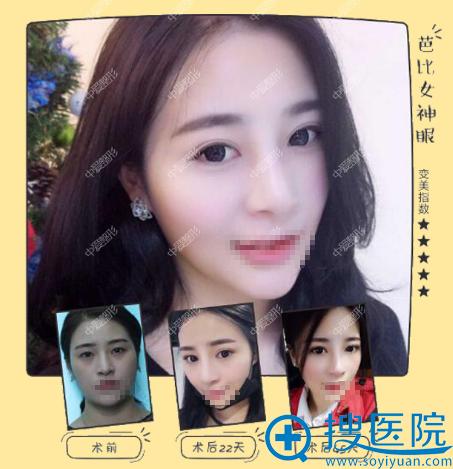 <!--<i data=20240710 data-id=12555></i>-->韩式三点微创双眼皮案例 <!--<i data=20240710 data-id=12555></i>-->韩式三点微创双眼皮案例