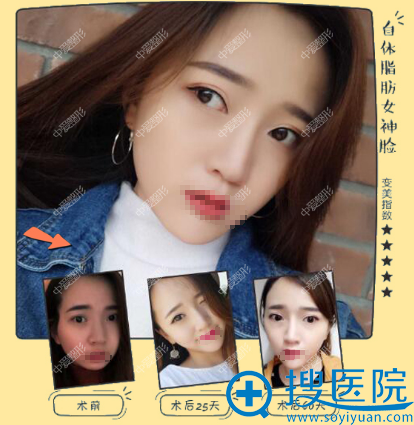 <!--<i data=20240710 data-id=12555></i>-->全面部脂肪填充案例 <!--<i data=20240710 data-id=12555></i>-->全面部脂肪填充案例